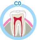虫歯の進行状態について 健康な歯（CO＝シーオー）