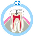 虫歯の進行状態について 中期虫歯（C2＝シーツー）