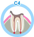 虫歯の進行状態について 末期虫歯（C4＝シーフォー）